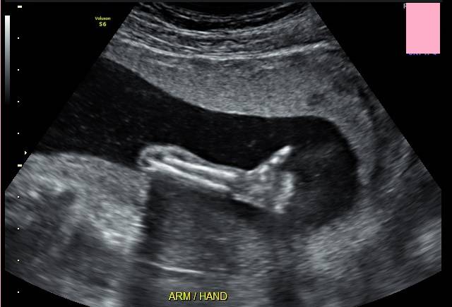 We went to the doctor the other day to see how the baby was coming along, I think everything's going to be ok.