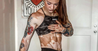 Girl With Vitiligo Learns To Accept Her Body Through Bodybuilding