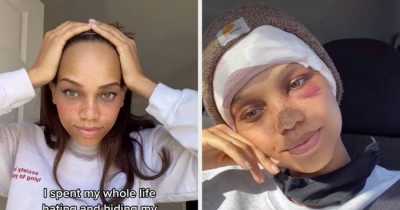Model Hated Her Big Forehead So Much She Actually Underwent Surgery To Reduce Its Size