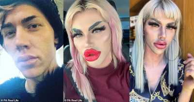 A Male Tech Expert Got Filler Worth $15,000 To Get The ‘Plastic Doll-like Look’