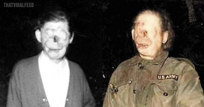 Raymond Robinson's Real-Life Tragic Story Of How He Became An Urban Legend ‘Charlie No-Face’