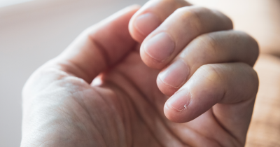 Doctor Shares Surprising Fingernail Clue That Could Reveal Your Lifespan