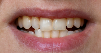 Dentist Explains Seven Common Reasons Your Teeth Turn Yellow And How To Prevent It