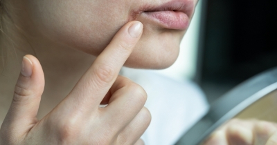 9 Natural Ways To Soothe Dry And Flaky Skin
