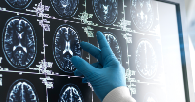 Study Suggests Marijuana Use May Be Linked To Higher Dementia Risk Within Five Years