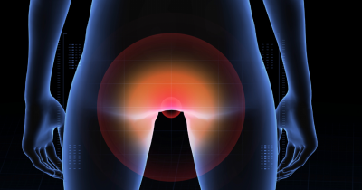 Anal Cancer Rates Rising Among Older Women, New Study Warns