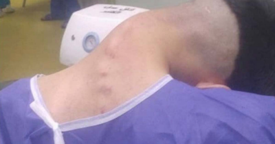 Man, 23, Suffers Rare 'Dropped Head Syndrome' After Years Of Drug Abuse